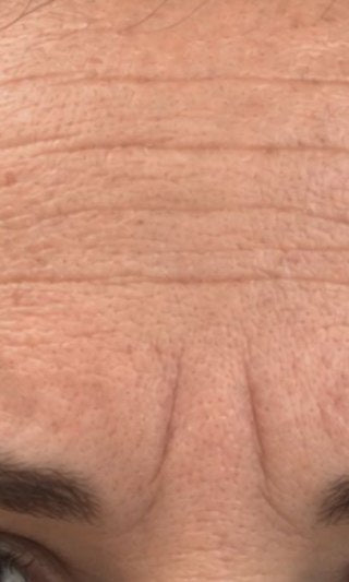 Fine lines & dryness